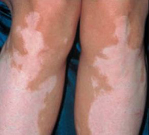 常见的腿部白斑病因是什么