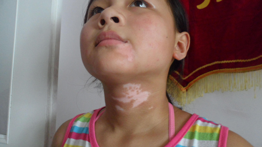 儿童皮肤出现白斑应该如何诊治