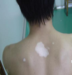 北京治疗白癜风专科医院：白癜风长在背部怎么治疗
